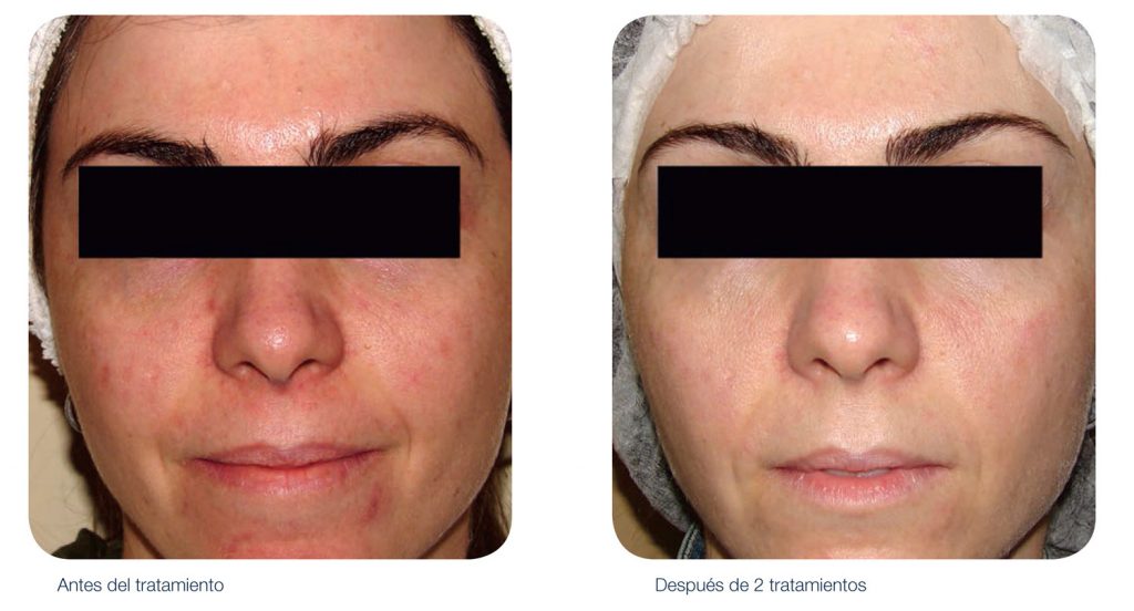 Antes y Después del tratamiento de rosacea con IPL M22